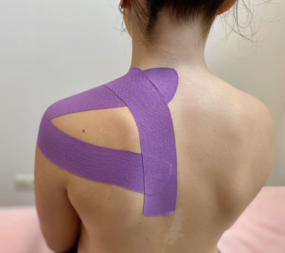 Mujer con vendaje neuromuscular en la espalda