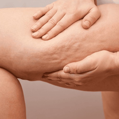 Celulitis en abdomen - tratamiento anticelulítico Azuqueca